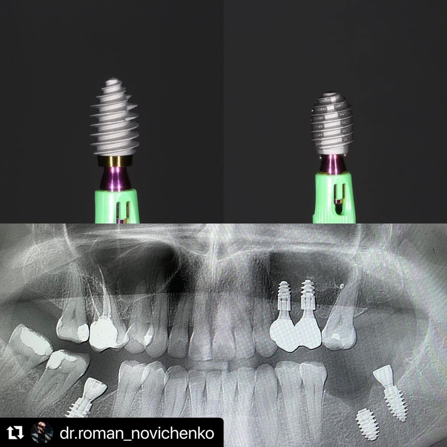 ROOTT R – Pro-TRATE, Implants ROOTT